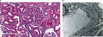 Thrombotic Microangiopathy, an Unusual Form of Monoclonal Gammopathy of Renal Significance: Report of 3 Cases and Literature Review